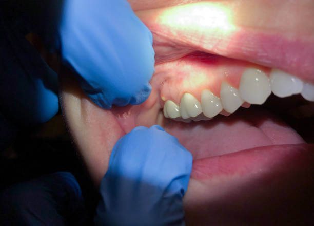 Best Emergency Denture Repair in West Yarmouth, MA