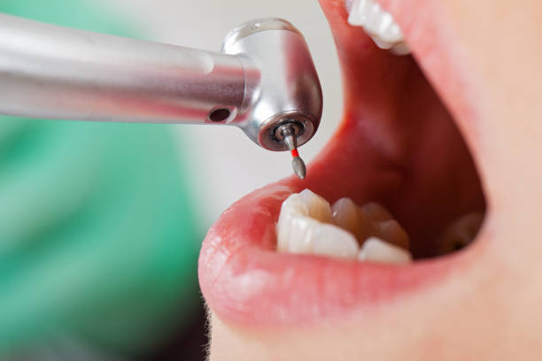 Best Lost Filling or Crown Replacement in West Yarmouth, MA